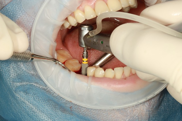 Sistema X-Guide para implantes dentales