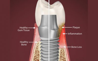 periimplantitis