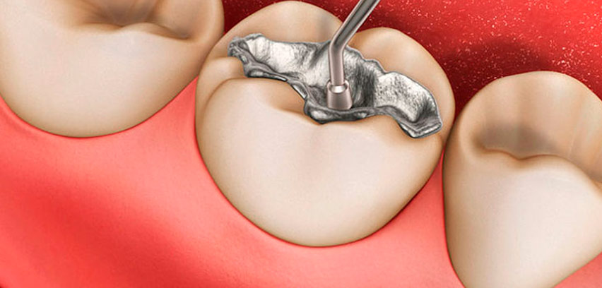  Se reduce el uso de amalgama en restauraciones dentales