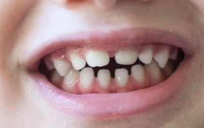 dientes de leche