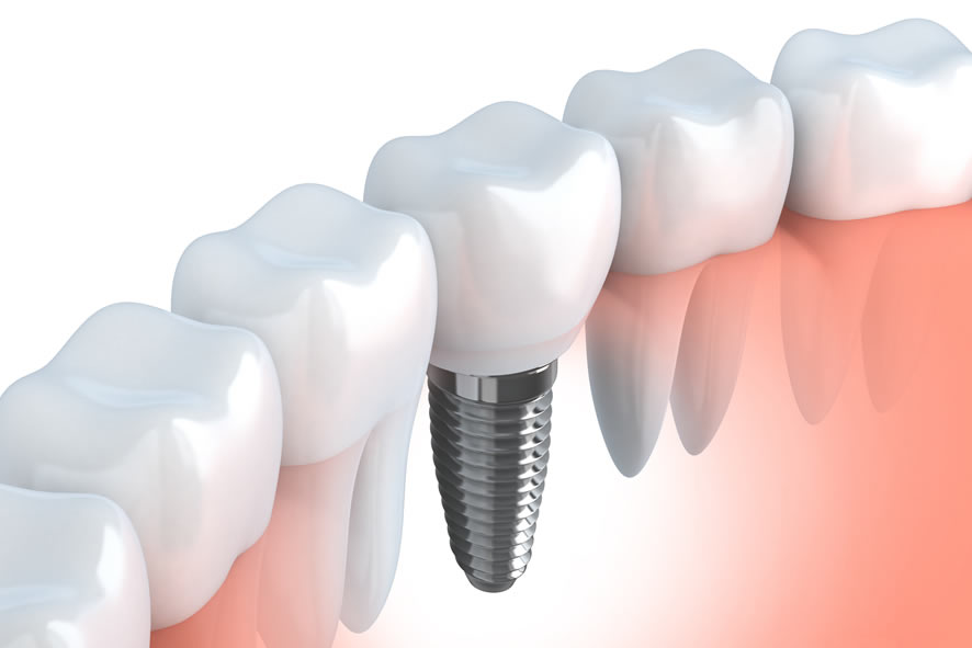 La implantología ofrece la posibilidad de disfrutar de una nueva dentición