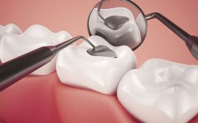 Empaste dental precio: 2 tipos de procedimientos