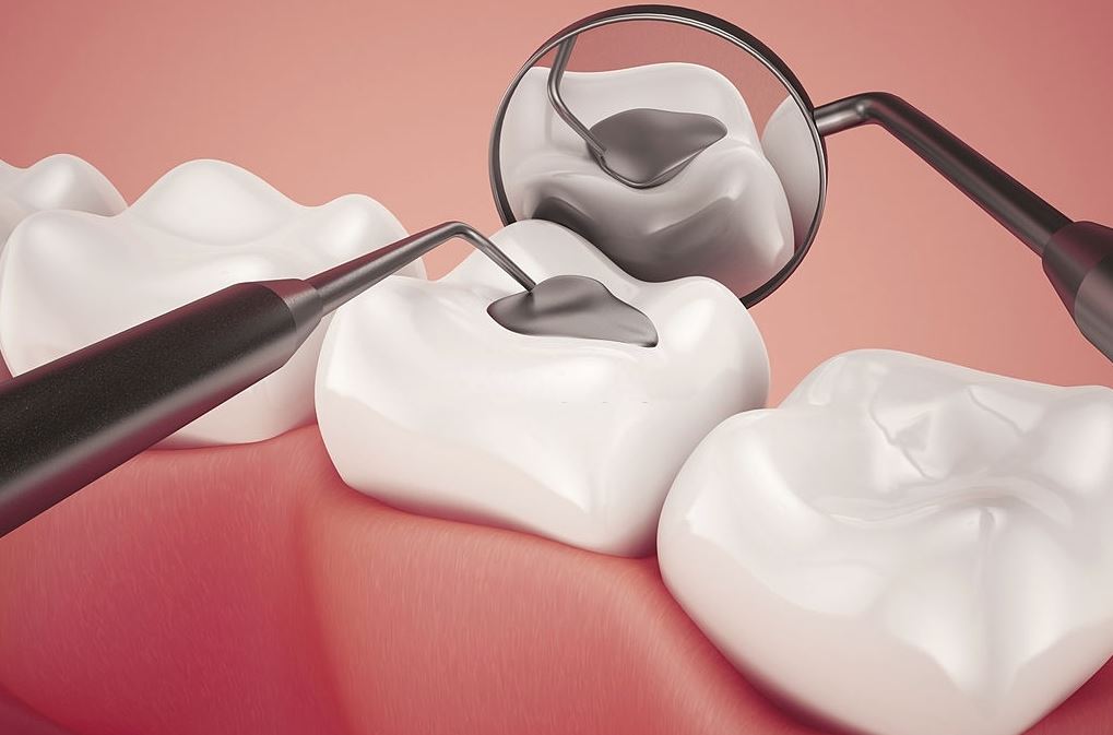 Empaste dental precio: 2 tipos de procedimientos
