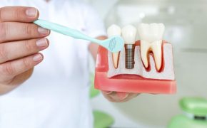 Seguros dentales para implantes: ¿Cómo funcionan?