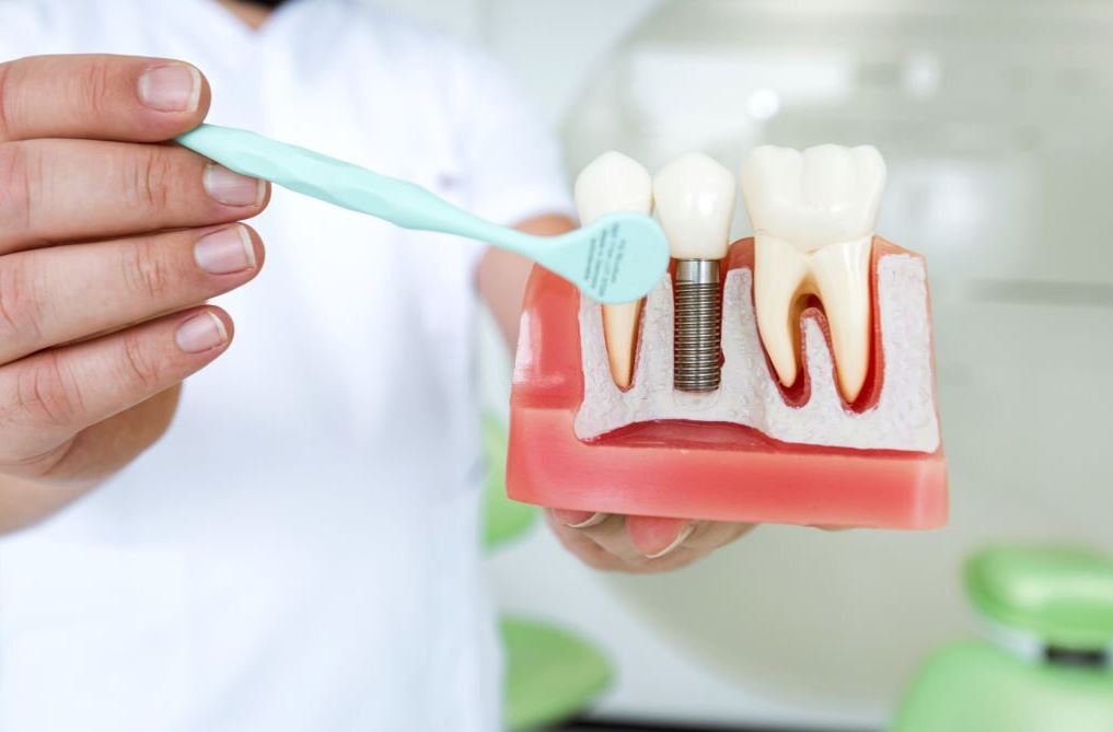seguros dentales para implantes