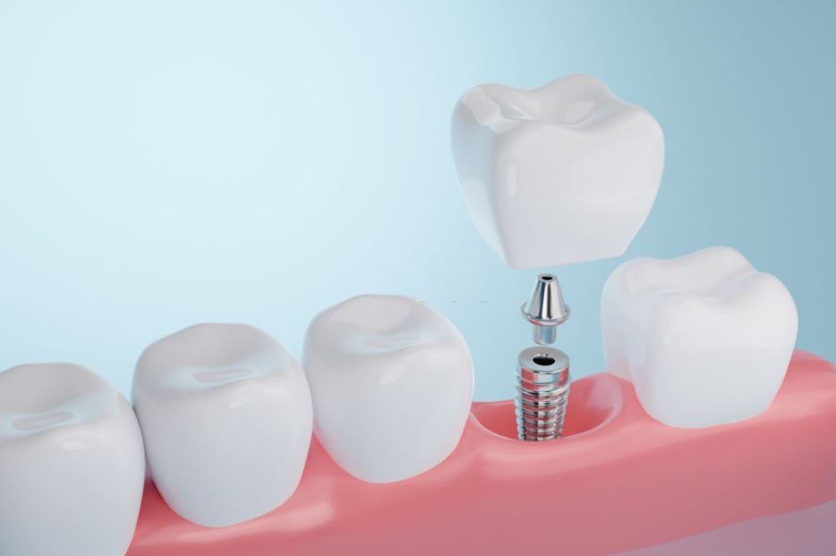 Seguro dental que cubra implantes: 4 Mejores Opciones
