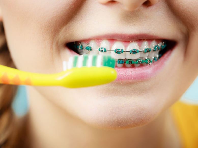 Mejor seguro dental para ortodoncia | 4 Mejores Opciones