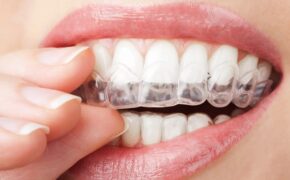 Precio ortodoncia invisible España