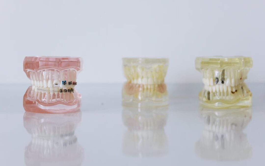 Invisalign o brackets