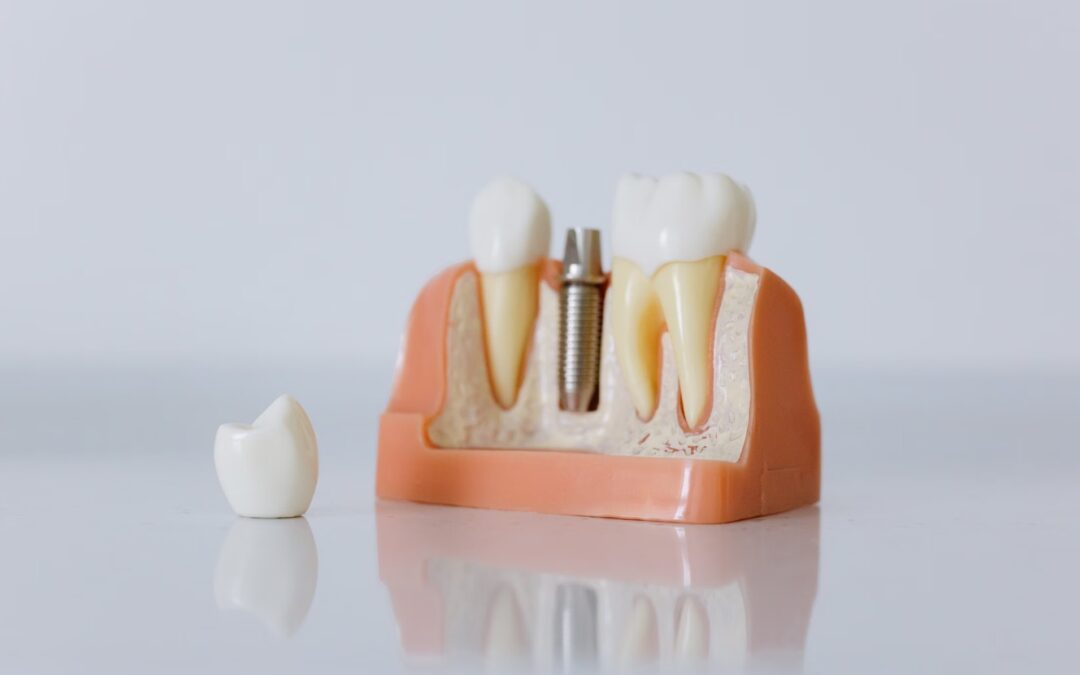 All-on-4 vs implantes tradicionales